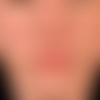 lupus erythematodes chronicus discoides: 25-year-old otherwise healthy patient. variable now disc...