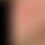 Lupus erythematodes tumidus: chronische, seit Monaten bestehende,&nbsp;wenig symptomatische, sukk...
