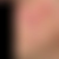 Lupus erythematodes tumidus: chronische, seit Monaten bestehende,&nbsp;wenig symptomatische, sukk...