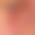 Lupus erythematodes chronicus discoides: großflächige, scharf begrenzte&nbsp;Plaque mit zentraler...