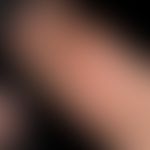 Lupus erythematodes chronicus discoides: zu deutlichen Mutilationen&nbsp;führender CDLE.&nbsp;Atr...