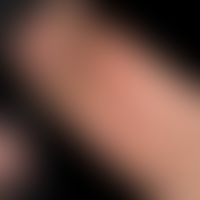 Lupus erythematodes chronicus discoides: zu deutlichen Mutilationen&nbsp;führender CDLE.&nbsp;Atr...