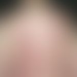 Lupus erythematodes tumidus: chronisches, seit 2 Jahren&nbsp; schubaktives,&nbsp;völlig symptomlo...