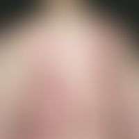 Lupus erythematodes tumidus: chronisches, seit 2 Jahren&nbsp; schubaktives,&nbsp;völlig symptomlo...