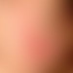 Lupus erythematodes tumidus: seit 4 Wochen&nbsp; existierende, wenig symptomatische, sukkulente, ...