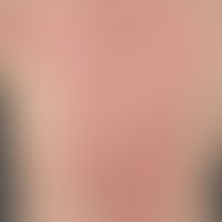 lupus erythematosus, subacute-cutaneous: clinical picture that has existed for several years, var...