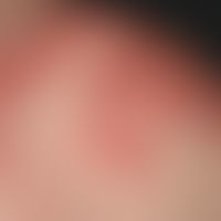 Lupus erythematodes, subakut-kutaner. Detailvergrößerung: Solitäre oder konfluierende, kleinfleck...
