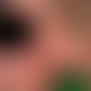 Lupus erythematodes, subakut-kutaner. Multiple, chronisch dynamische, zunehmende, kleine oder flä...
