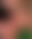 Lupus erythematodes, subakut-kutaner. Multiple, chronisch dynamische, zunehmende, kleine oder flä...