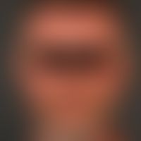 Lupus erythematosus acute-cutaneous: symmetrical red spots, patches and plaques in the face, neck...