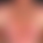 lupus erythematosus acute-cutaneous: large and small succulent plaques, with sharply defined circ...