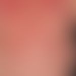 lupus erythematosus acute-cutaneous: clinical picture occurred within 14 days, at the time of adm...