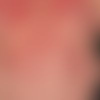 lupus erythematosus acute-cutaneous: clinical picture occurred within 14 days, at the time of adm...
