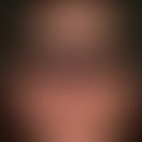 lupus erythematosus acute-cutaneous: acute symmetrical skin symptoms after sun exposure, which ha...
