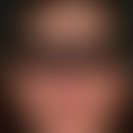 lupus erythematosus acute-cutaneous: acute symmetrical skin symptoms after sun exposure, which ha...