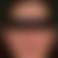 lupus erythematosus acute-cutaneous: acute symmetrical skin symptoms after sun exposure, which ha...
