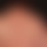 Lipomatosis benign symmetric: Type II pseudoathletic type, which has existed for years and has ch...