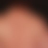 Lipomatosis benign symmetric: Type II pseudoathletic type, which has existed for years and has ch...