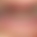 Angiom seniles der Lippen: sog. Lippenrandangiom (venous lake). Beidseitige bläuliche weiche, ein...