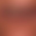 Cyanosis of the lips
