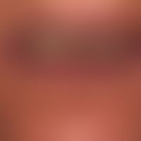 Cyanosis of the lips
