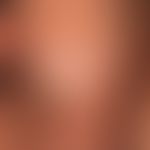 Lichen sclerosus of the penis: advanced findings with broad synechia of glans penis and inner pre...