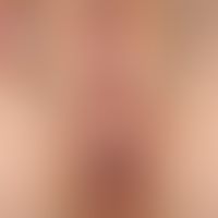 Lichen sclerosus der Vulva: Befall von Vulva und Anus in einer achter-Form.
