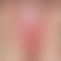 Lichen sclerosus der Vulva: flächige Sklerosierung der großen Labien und des Perineums. Umgebende...