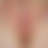 Lichen sclerosus der Vulva: flächenhafte weißliche Sklerosierung der großen Labien; bisher&nbsp;b...