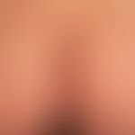 Dermatitis herpetiformis: Multiple, prickly, itchy, scratched excoriations on the buttocks of a 3...