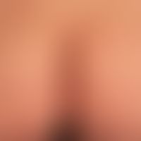Dermatitis herpetiformis: Multiple, prickly, itchy, scratched excoriations on the buttocks of a 3...