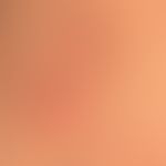 Dermatitis herpetiformis: chronically recurrent course of the disease; detailed picture of a urti...