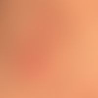 Dermatitis herpetiformis: chronically recurrent course of the disease; detailed picture of a urti...
