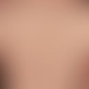 Dermatitis herpetiformis:&nbsp;chronisch rezidivierender&nbsp;Krankheitsverlauf. Besteht seit &nb...
