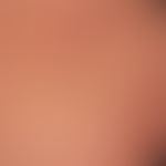 Dermatitis herpetiformis: Multiple, prickly, itchy, scratched excoriations in a 35-year-old femal...
