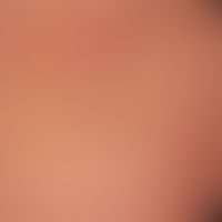 Dermatitis herpetiformis: Multiple, prickly, itchy, scratched excoriations in a 35-year-old femal...