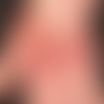 Dermatosis, acute febrile neutrophils (Sweet syndrome):suddenly distended generalized clinical pi...