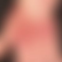 Dermatosis, acute febrile neutrophils (Sweet syndrome):suddenly distended generalized clinical pi...
