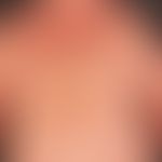 Dermatosis, acute neutrophils: reddish-livid, succulent, pressure-dolent, infiltrated, solitary a...