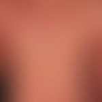 Eczema atopic (erythrodermal): severe, universal (erythrodermal) atopic eczema, exacerbation phas...