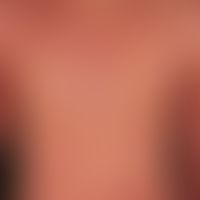 Eczema, atopic erythrodermic. Exacerbation of a previously known atopic eczema. 3 months of eryth...