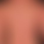 Ekzem, atopisches erythrodermisches. Exazerbation eines vorbekannten atopischen Ekzems. Seit 3 Mo...