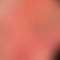 Kontaktdermatitis allergische mit flächiger Ausbildung von Bläschen und massiver Schwellung der L...