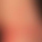 Allergie Typ IV-Reaktion: akutes kontaktallergisches Ekzem mit Streureaktion nach Auftragen eines...