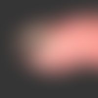 Thrombangiitis obliterans&nbsp;(Endangiitis obliterans): ältere Nekrose der Fingerspitze.
