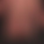 Thrombangiitis obliterans: 48-year-old female patient; decades of nicotine abuse. 12 months of ac...