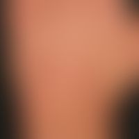 Baker's eczema with known flour protein allergy; chronic recurrent hand eczema, the acuteity of w...