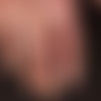 Dyshidrotische Dermatitis:&nbsp;Zustand nach großblasigem Schub des Ekzems (sog. Cheiropompholyx)...