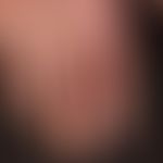 Cheiropompholyx: Zustand nach großblasigem Schub des vorbekannten, chronisch-rezidivierenden, dys...