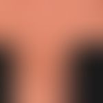 Schwere aktinische Elastose: Detailausschnitt
